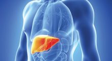 Nonalcoholic Steatohepatitis NASH