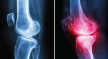 Rheumatoid Arthritis and Psoriatic Arthritis
