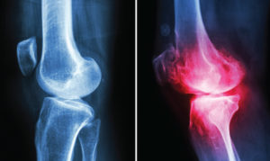 Rheumatoid Arthritis and Psoriatic Arthritis