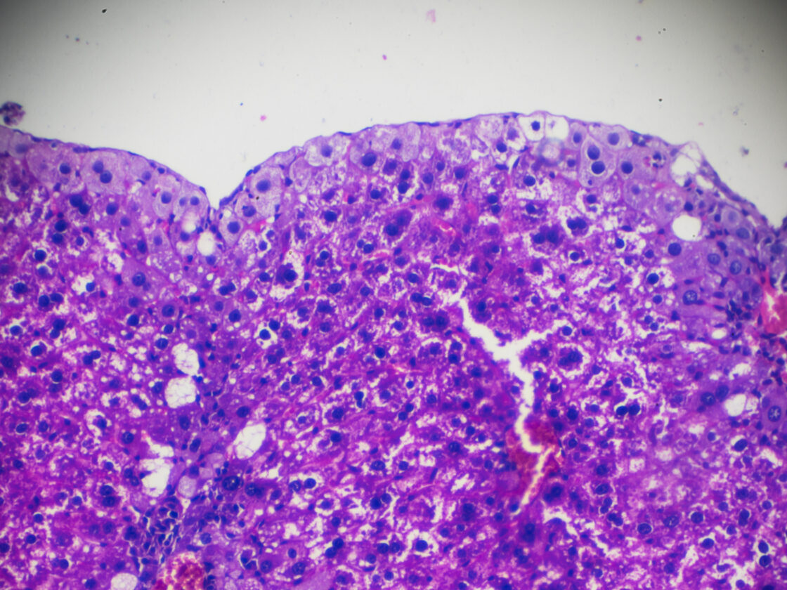 Acute ordinary hepatitis liver biopsy under light microscopy