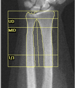 DXA imaging