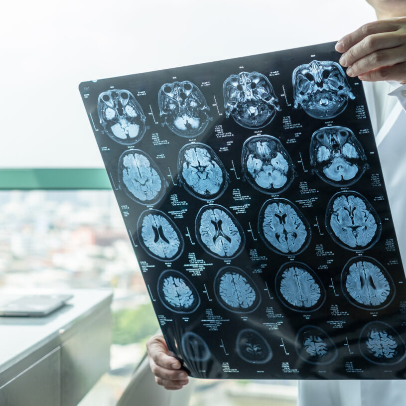 medical doctor seeing Magnetic Resonance Imaging (MRI) film