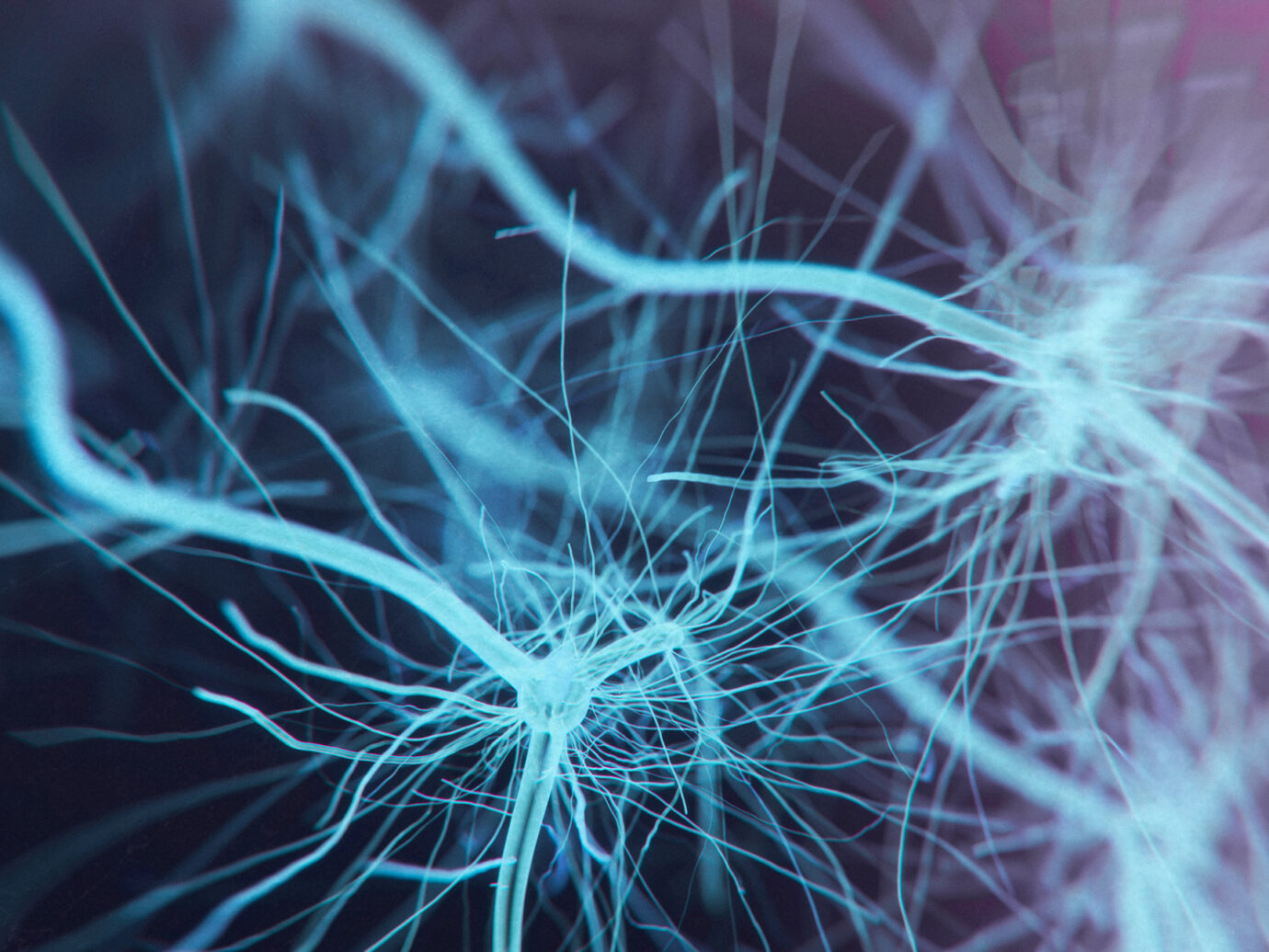 stroke case study
