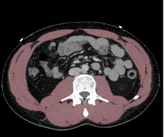 Muscle segmentation on CT images